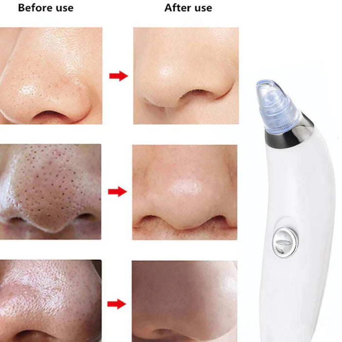 VacPro - Derma Suction Vacuum